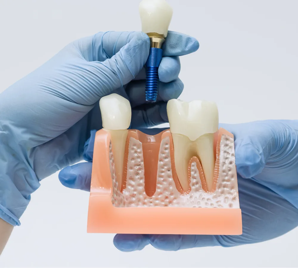 Why dental implants in Haddonfield offer more than a new smile