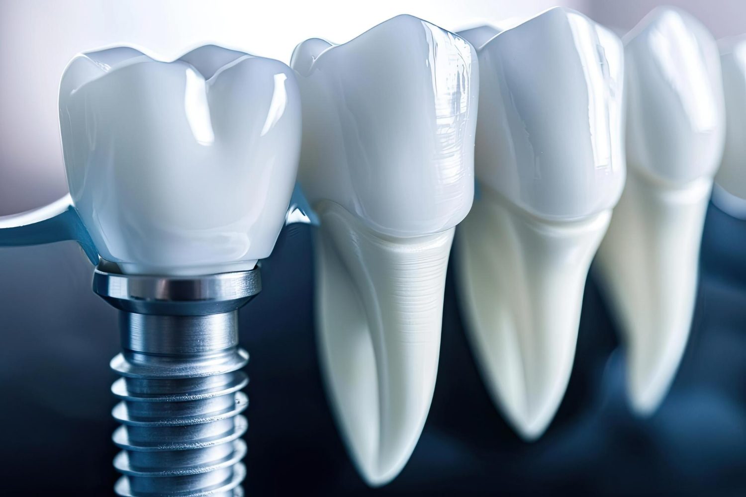implants